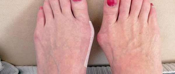 Причины и лечение шишек на ногах